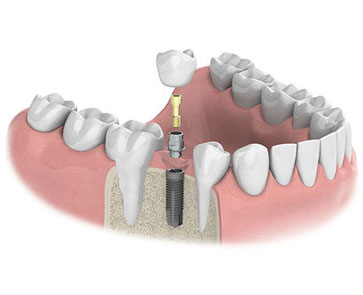 implantat-mit-einzelkrone-1.jpg