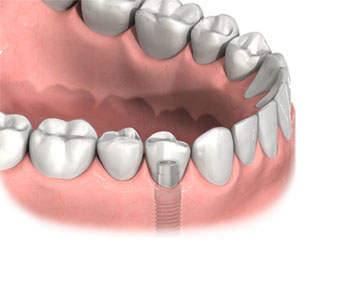 implantat-mit-einzelkrone-2.jpg