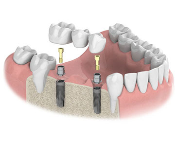 implantatgetragene-bruecke-1.jpg