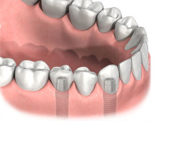 implantatgetragene-bruecke2.jpg